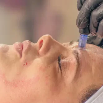 Tratamento anti manchas